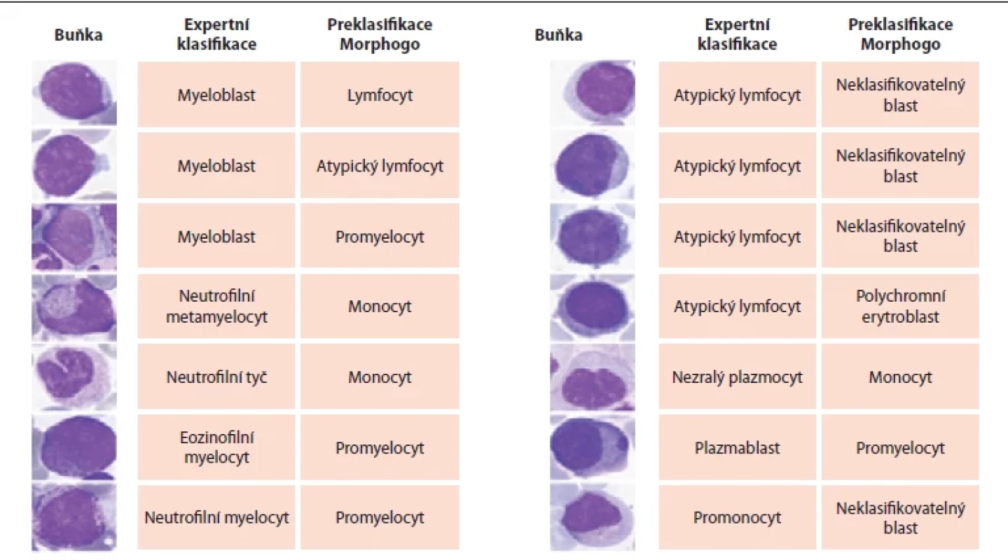 Chybné klasifi kace při ADM kostní dřeně s využitím Morphogo.
