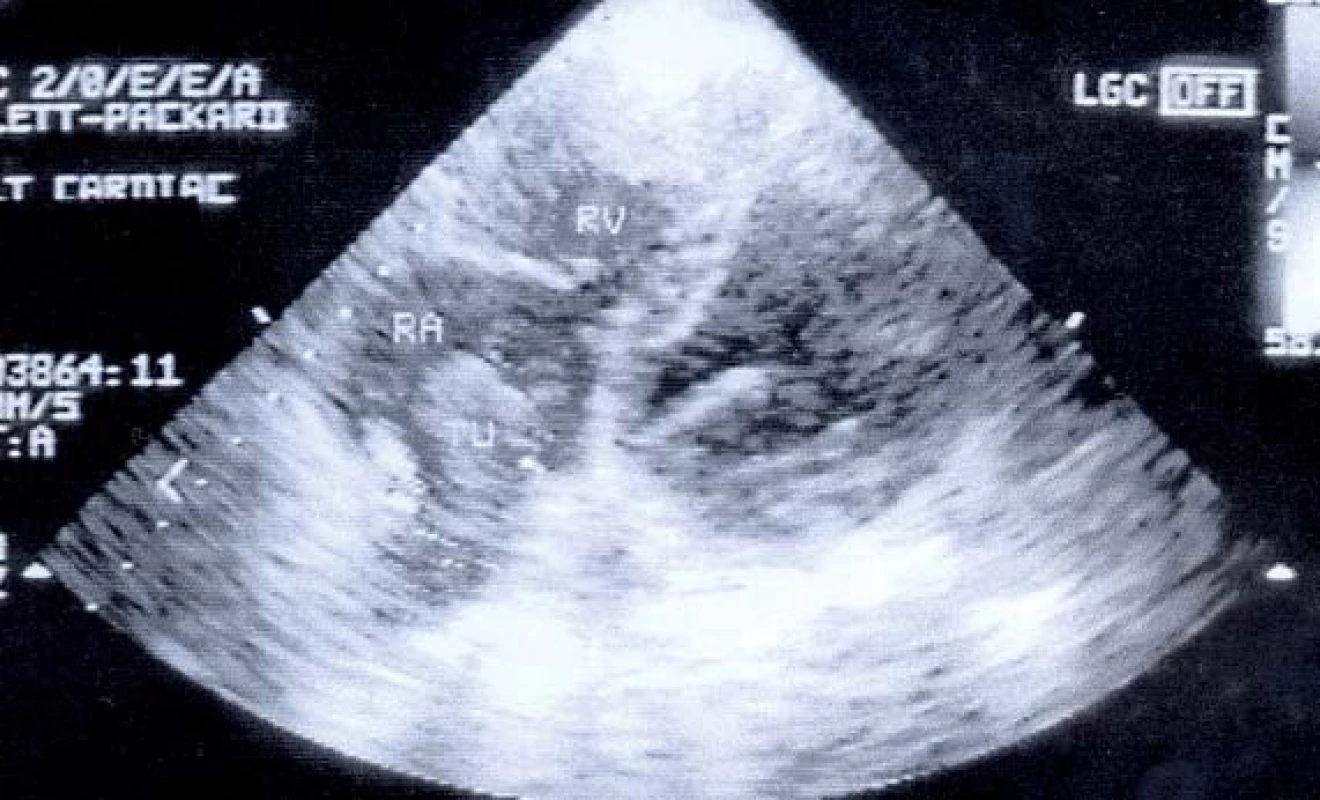 Sonografie – válcovitý trombus v pravé síni.