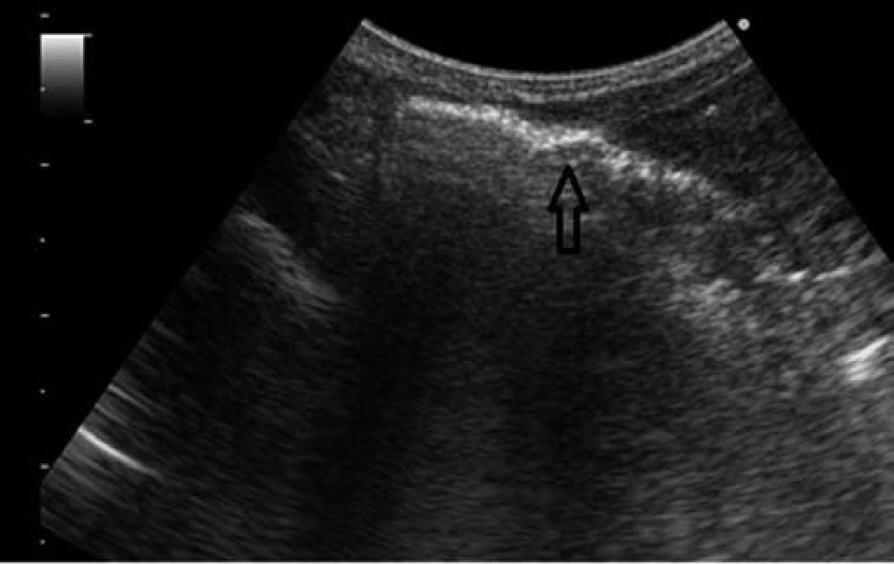Sonografické vyšetrenie – vzduch v črevnej stene.
Fig. 4. Sonographic examination – air in the intestinal wall.