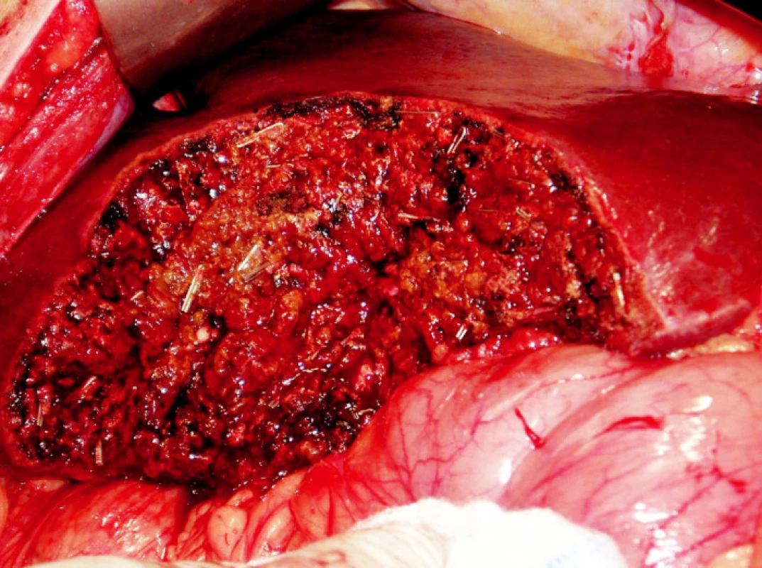 Resekční plocha jater
Obr. 1. Raw surface of the transected liver