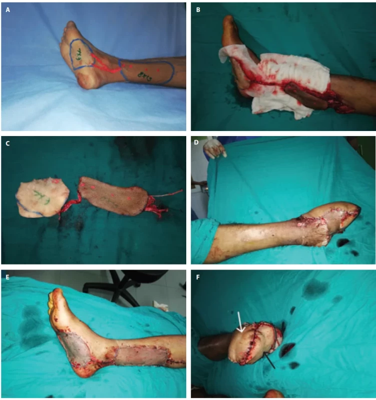 A) fl ap design, B) fl ap harvest, C) fl ap after separation with its two components, D, E) donor-site morbidity and F) fl ap after insetting. White arrow in F pints to posterior tibial fl ap while black one points to medial plantar fl ap.