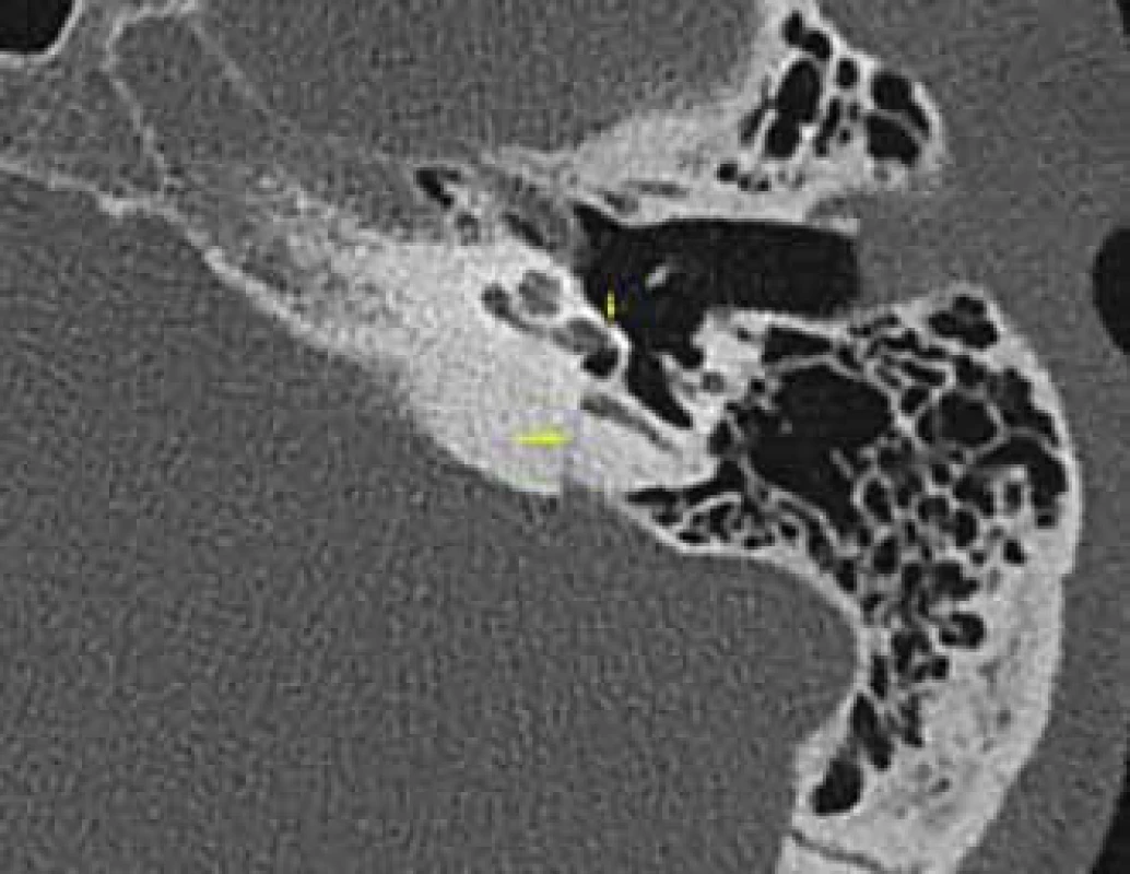 Transverzální fraktura spánkové kosti, HRCT, axiální rovina.
Fig. 2. Transversal fracture of temporal bone, HRCT, axial plane.