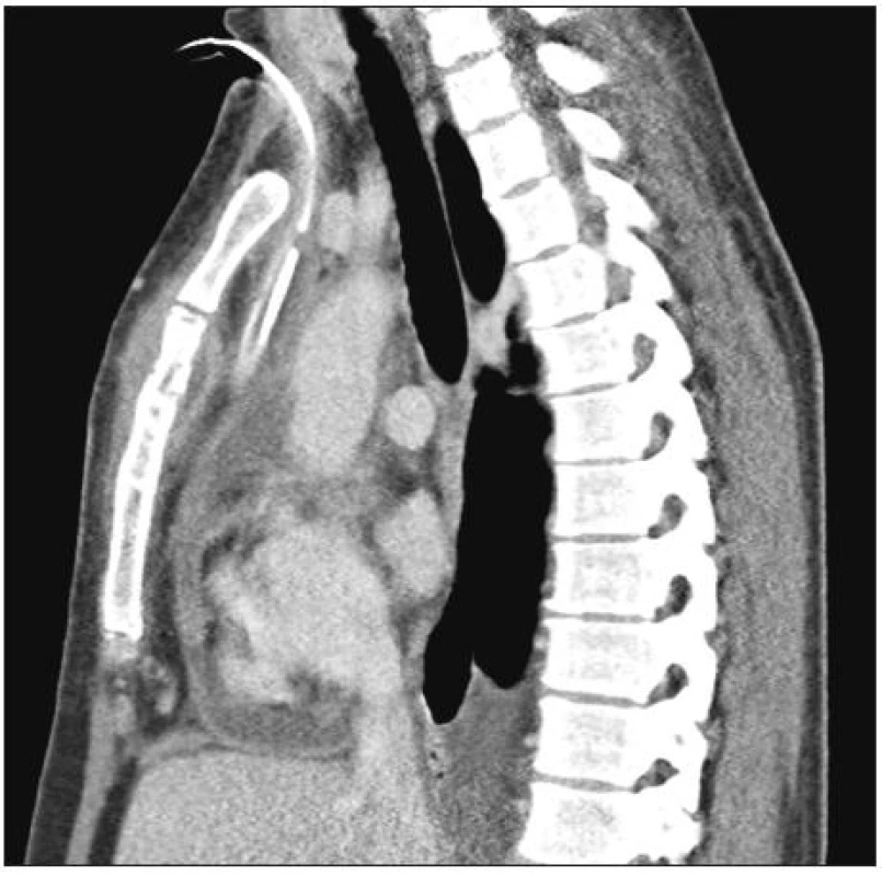 Z.n. Mediastinotomie und Abszess-Evakuationmit Drainage des vorderen Abszesses im Unterhaut-Sternalgebiet (sagittaler Schnitt)