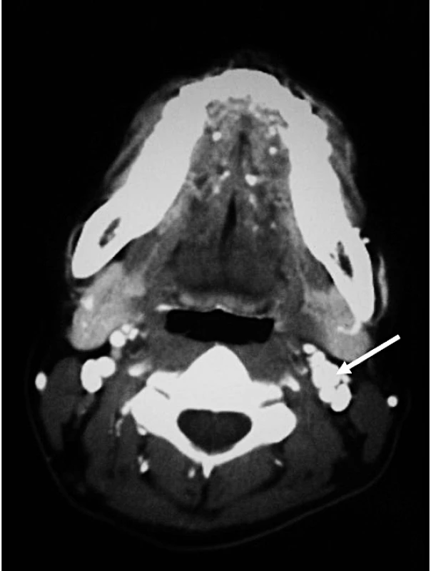 Computer Tomography Showing a 9 mm Well-Defined Hypervascular Nodule Present in Left Carotid Bifurcation, Suggestive of a Carotid Body Tumour