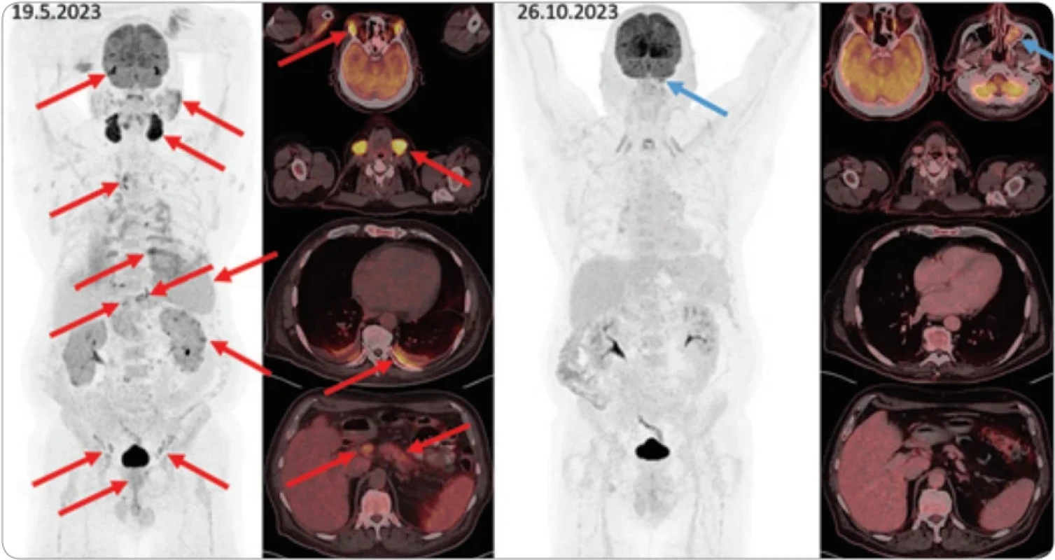 Pacient (ročník 1952) přišel v roce 2023 s generalizovanou lymfadenopatií, zduřením slinných žláz a symptomy Sicca syndromu. Posléze se přidala vaskulitida s kožními projevy a poškození ledvin s nefrotickým syndromem. Po léčbě rituximabem a cyklofosfamidem se dostal do kompletní remise a nyní probíhá udržovací léčba rituximabem. Šlo o rozsáhlé poškození odpovídající Mikuliczově fenotypu této nemoci. Iniciální FDG-PET/CT vyšetření (vlevo) a kontrolní vyšetření při terapii (vpravo), vždy MIP sken hlavy a trupu a fúzované axiální řezy s detaily. Na iniciálním vyšetření jsou extrémně metabolicky aktivní slzné žlázy (akumulace dokonce přesahuje fyziologicky vysokou akumulaci v mozku) a podčelistní slinné žlázy. Zvýšené akumulace 18F-FDG jsou patrny i v příušních a podjazykových slinných žlázách, uzlinách periklavikulárně, mediastina, epigastria, retroperitonea a ilicky oboustranně, dorzálně v plicích, kde je i fluidotorax, v hlavě a těle slinivky, ložiska v kůře ledvin, aktivnější prostata, slezina difuzně aktivnější než játra (tyto patologie jsou označeny červenými šipkami). Na kontrolním vyšetření při terapii všechny tyto nálezy vymizely, nově jediná akumulace vlevo v maxilární dutině (modré šipky, vs. zánět bez souvislosti se základní diagnózou).