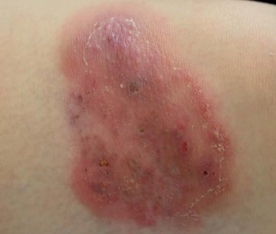 Pyoderma gangrenosum.
Fig. 2. Pyoderma gangrenosum.