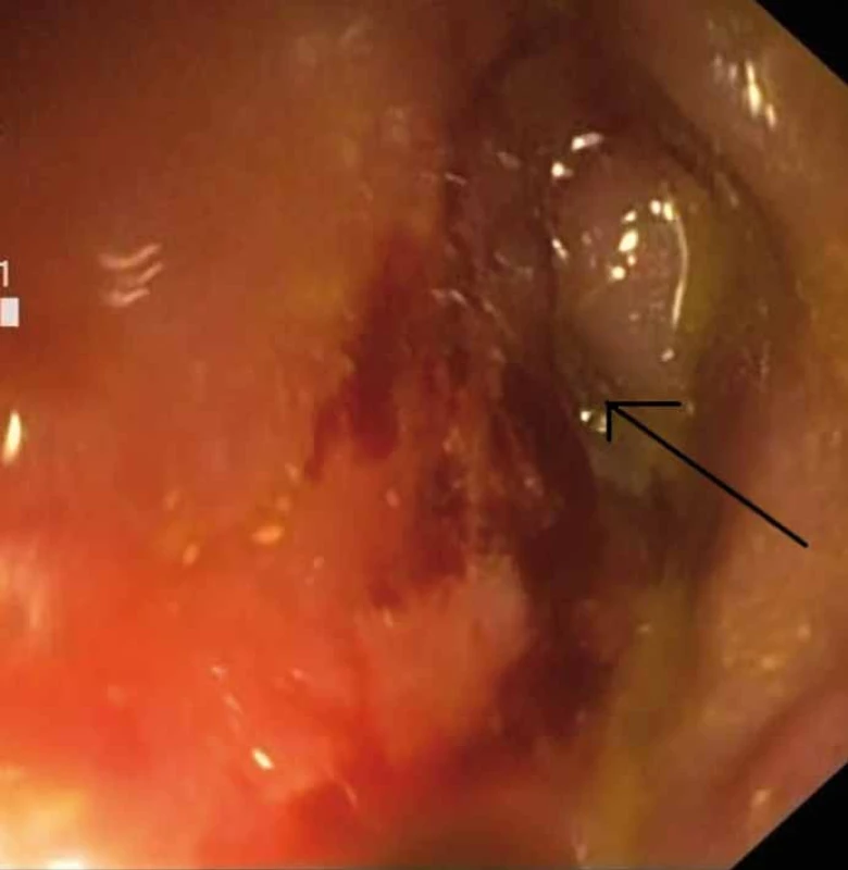 Stenóza střeva při vstupním vyšetření (označeno lumen). 
Fig. 1. Stenosis of the bowel at baseline (marked lumen).