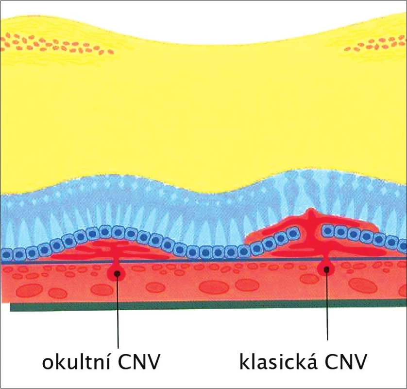 Typy chorioidálních neovaskulárních membrán dle Gasse