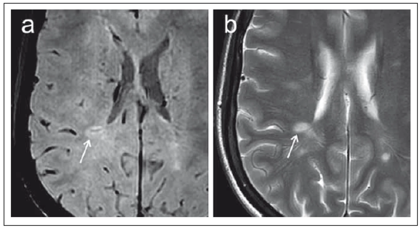 Porovnání sekvence SWI (susceptibility-weighted imaging) (a) a konvenčního T2 váženého obrazu (b) v axiální rovině u pacientky s roztroušenou sklerózou.
Fig. 3. Comparison of the SWI (susceptibility-weighted imaging) (a) sequence and a conventional T2-weighted image (b) in the axial plane in a patient with multiple sclerosis.