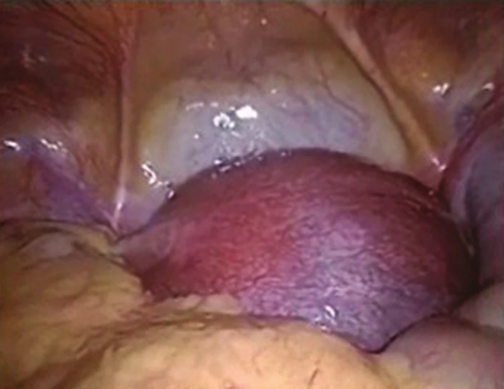 Pohled na těhotnou dělohu
Fig. 1: View of the gravid uterus