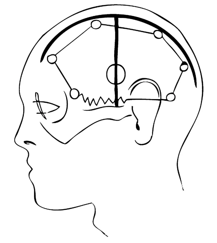 Kožní řez tvaru „T“
Pic. 3. “T“-shaped skin section