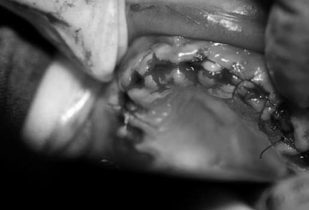 Sutura extrakčních ran.
Fig. 6. Suture the wounds after the extractions.