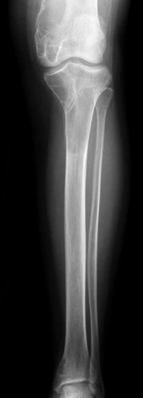 Patologická fraktúra pravej dolnej končatiny – rozsiahle cystické zmeny distálneho femuru a proximálnej tíbie.
Fig. 1. Pathologic fracture of the right lower extremity – vast cystic changes of distal femur and proximal tibia.