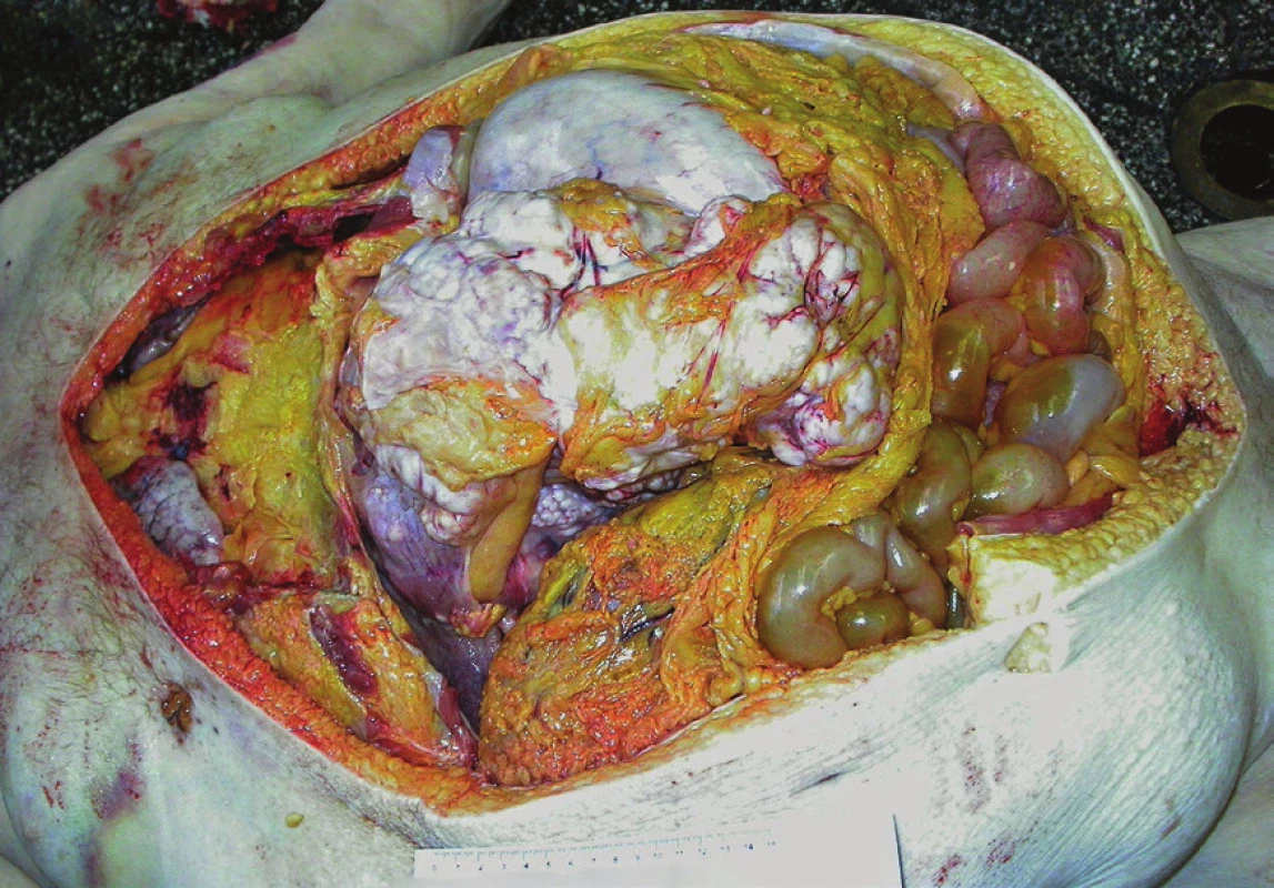 Muž, 75 let, zemřel náhle doma, byla prováděna resuscitace. Dle dokumentace se léčil se srdcem, měl hypertenzi, diabetes mellitus, bércové vředy, obezitu. Příčinou úmrtí byl rozsáhlý zhoubný měkkotkáňový nádor v dutině břišní, s maximem nádorových mas v pravém horním kvadrantu a centrální oblasti břicha. Mikroskopicky byl diagnostikován nízce diferencovaný sarkom.
