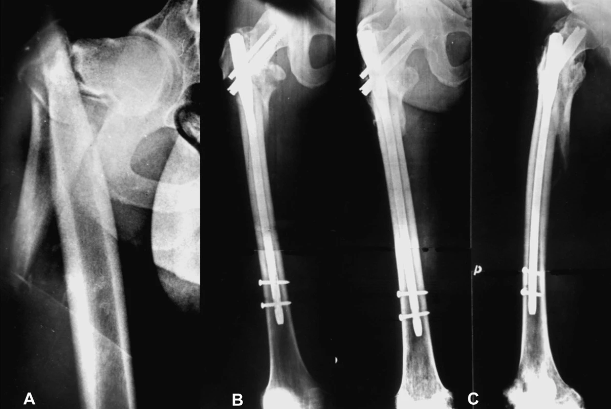 Vysokoenergetické poranění u 25letého muže: a – úrazový snímek, komplexní zlomeniny jdoucí od baze krčku až do oblasti diafýzy; b – osteosyntéza dlouhým PFN Synthes; c – zhojení zlomeniny po 6 měsících.
Fig. 3: High-energy trauma in 25-year old man: a – complex fracture of the proximal end and femoral shaft, the fracture begins basicervically and the comminuting zone continues to the region of the femoral shaft; b – fixation with a long PFN Synthes; c – the fracture demonstrating solid union 6 months later.