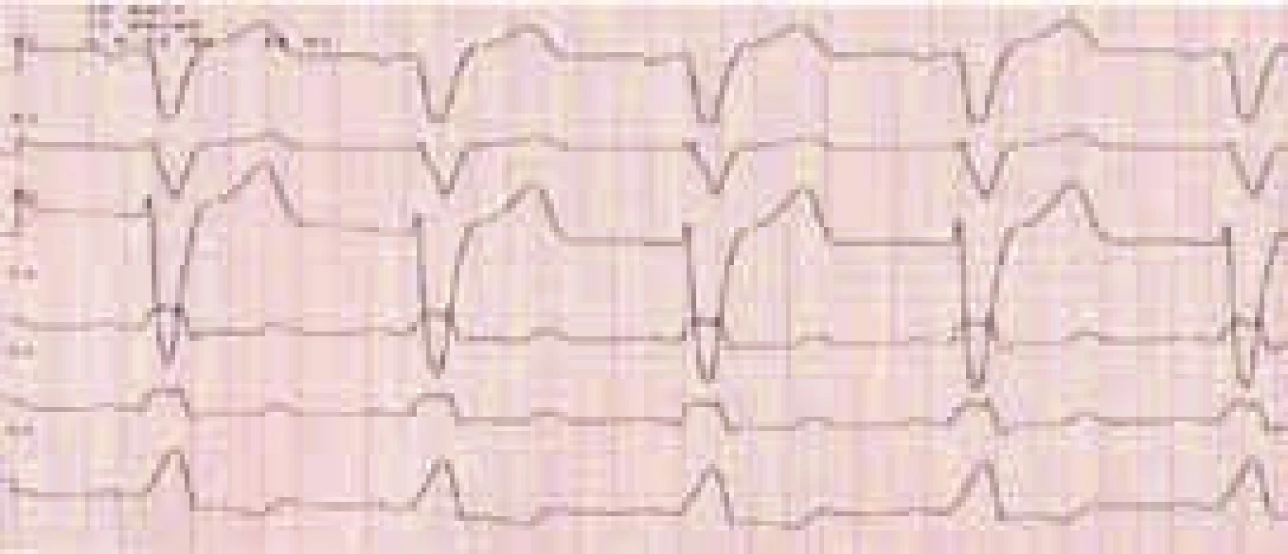 Blokáda ľavého Tawarovho ramienka so šírkou QRS komplexu 160 ms. Vo zvode V<sub>1</sub> je prítomný hlboký S kmit, naopak absentuje R kmit. Vo zvode V<sub>5</sub> nadobúda QRS komplex morfológiu RsŔ (materiál Kliniky kardiológie LF UPJŠ a VÚSCH a.s., Košice)