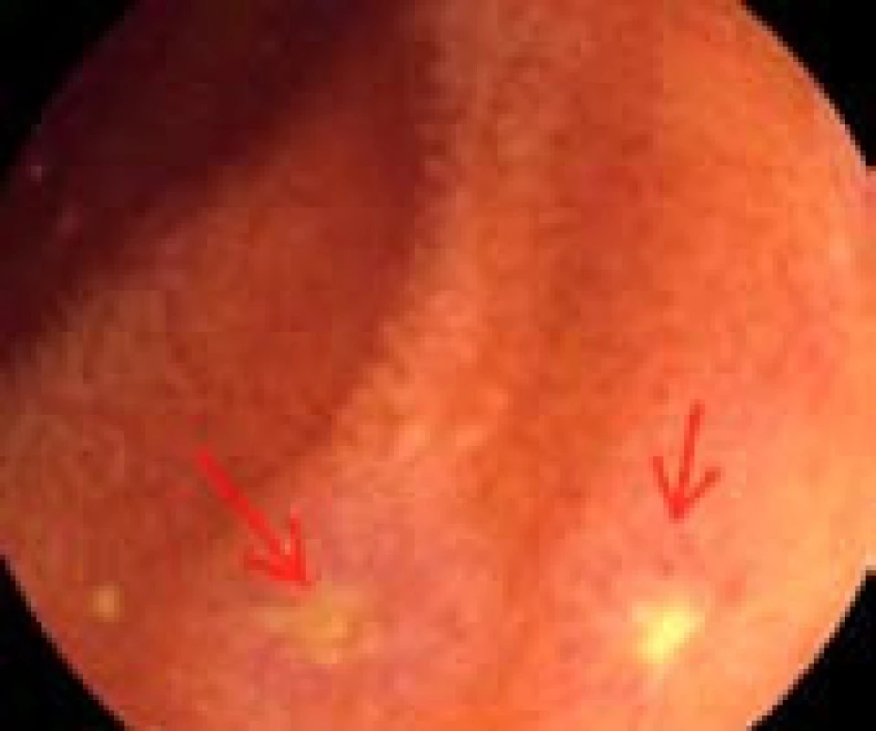 Povrchové aftózní eroze v jejunu (šipky). 
Fig. 1. Superficial aphthous erosions in the jejunum (arrows).