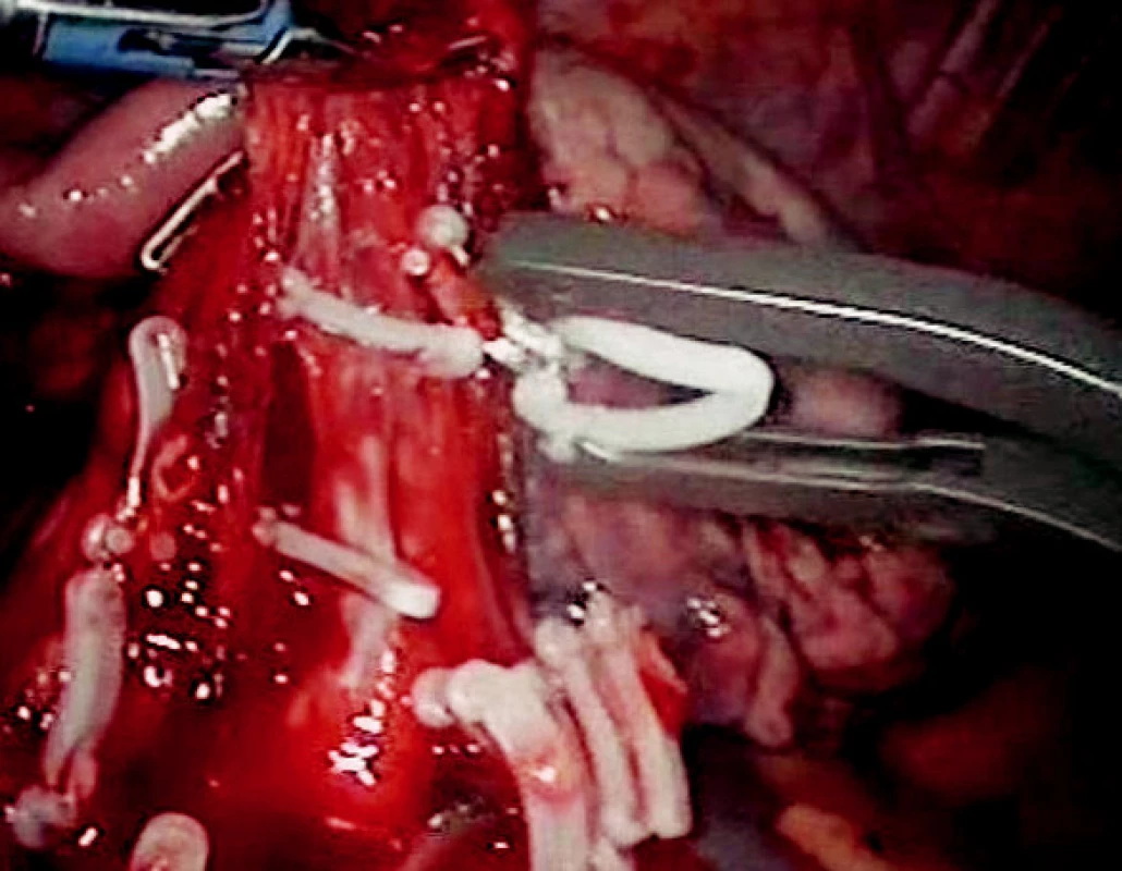 Aplikace hemoklipů na větvě pulmonální pro horní lalok
Fig. 4. Application of hemoclips on the upper lobe pulmonary branch