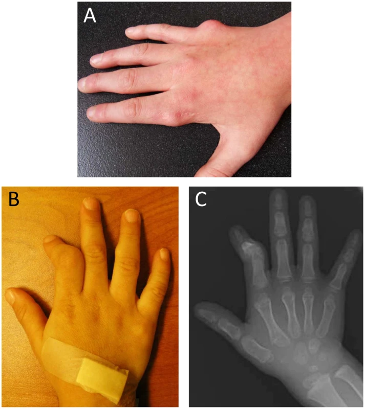 Manifestations of metachondromatosis.