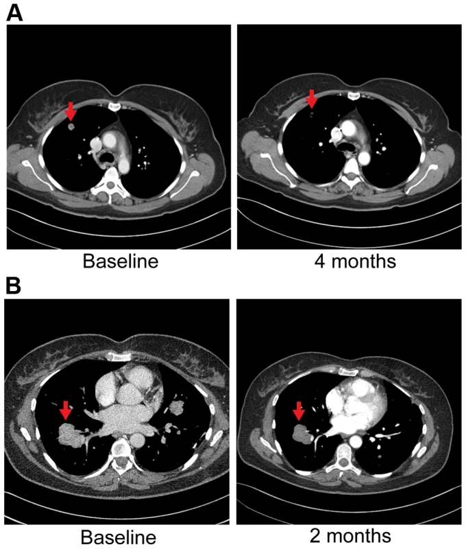 Anti-tumor activity in Patient 6, harboring an <i>FGFR2-TACC3</i> fusion, to FGFR inhibitors.