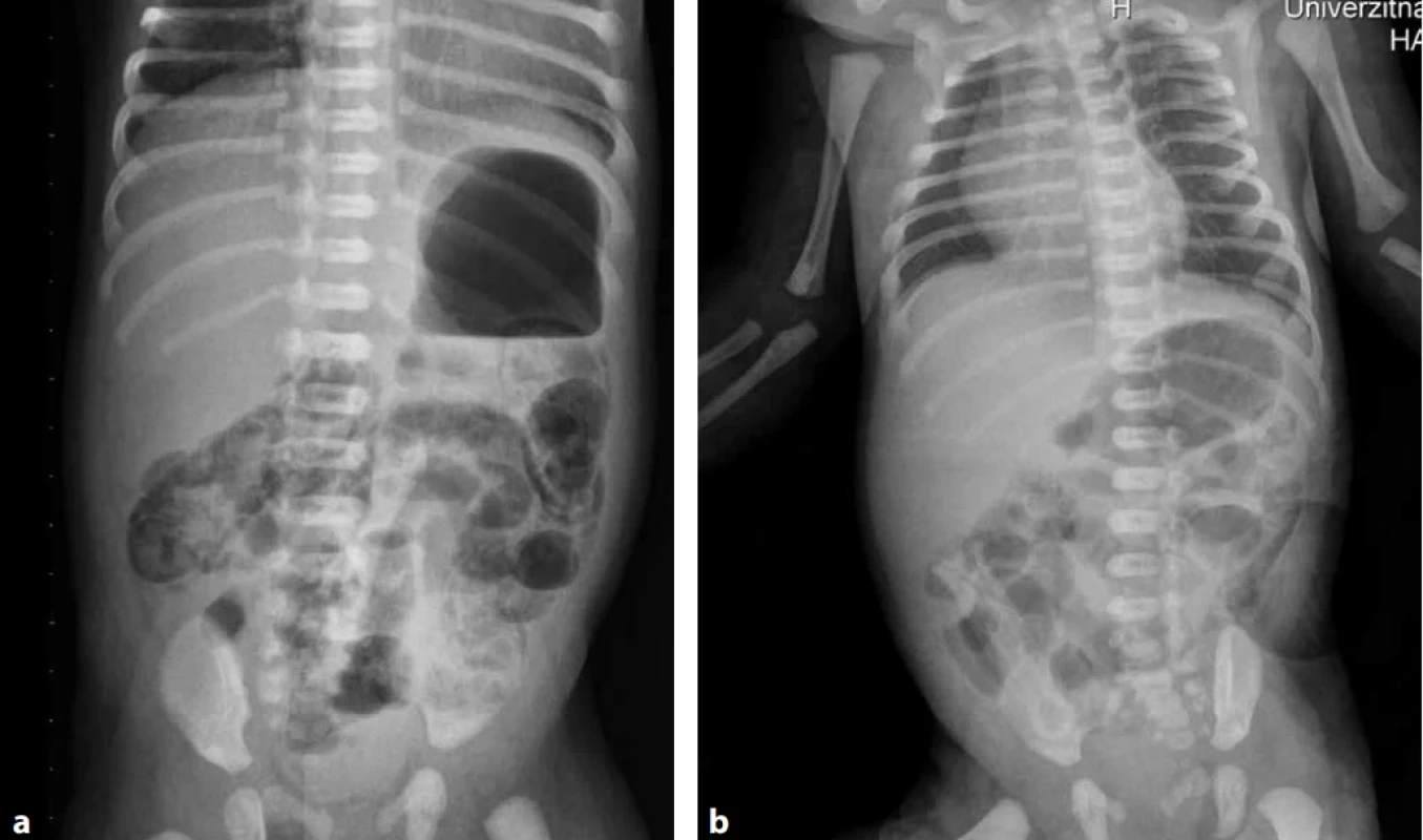 RTG obrazy intestinálnej pneumatózy (z archívu Neonatologickej kliniky JLF UK a UNM)