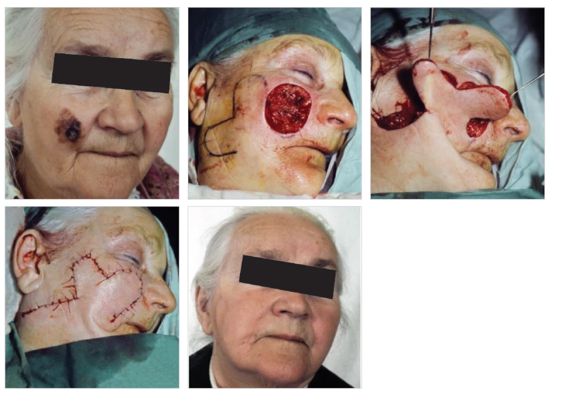 Krytí defektu obličeje dvojitým lalokem po odstranění kožního nádoru
Fig. 1: Coverage of a facial defect with a bilobed flap after removal of a skin tumor