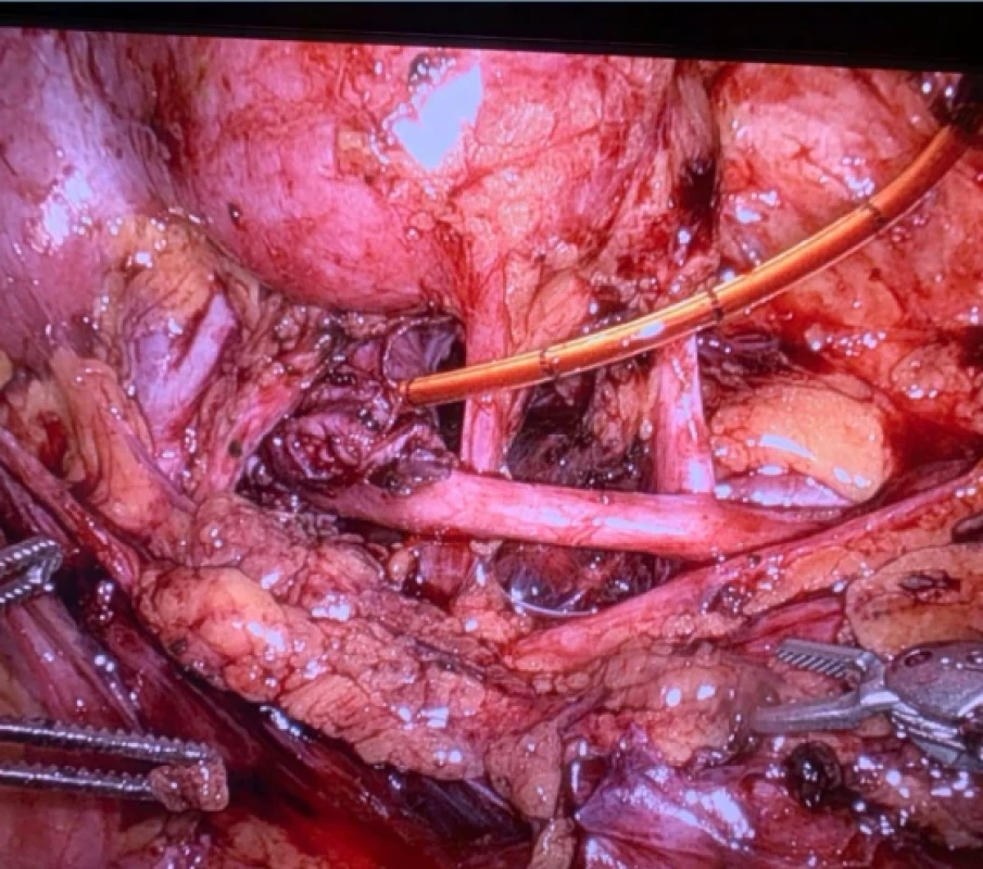 Zavedená pyelostomie do ledvinné pánvičky a vedená retroperitoneem kolem dolního pólu ledviny u 12letého pacienta s křižující akcesorní cévou vedoucí k dolnímu pólu levé ledviny. Fig. 3. Pyelostomy inserted into the renal pelvis and placed retroperitoneally around the lower pole of the kidney in a 12-year-old patient with a crossing accessory vessel supplying the lower pole of the left kidney.