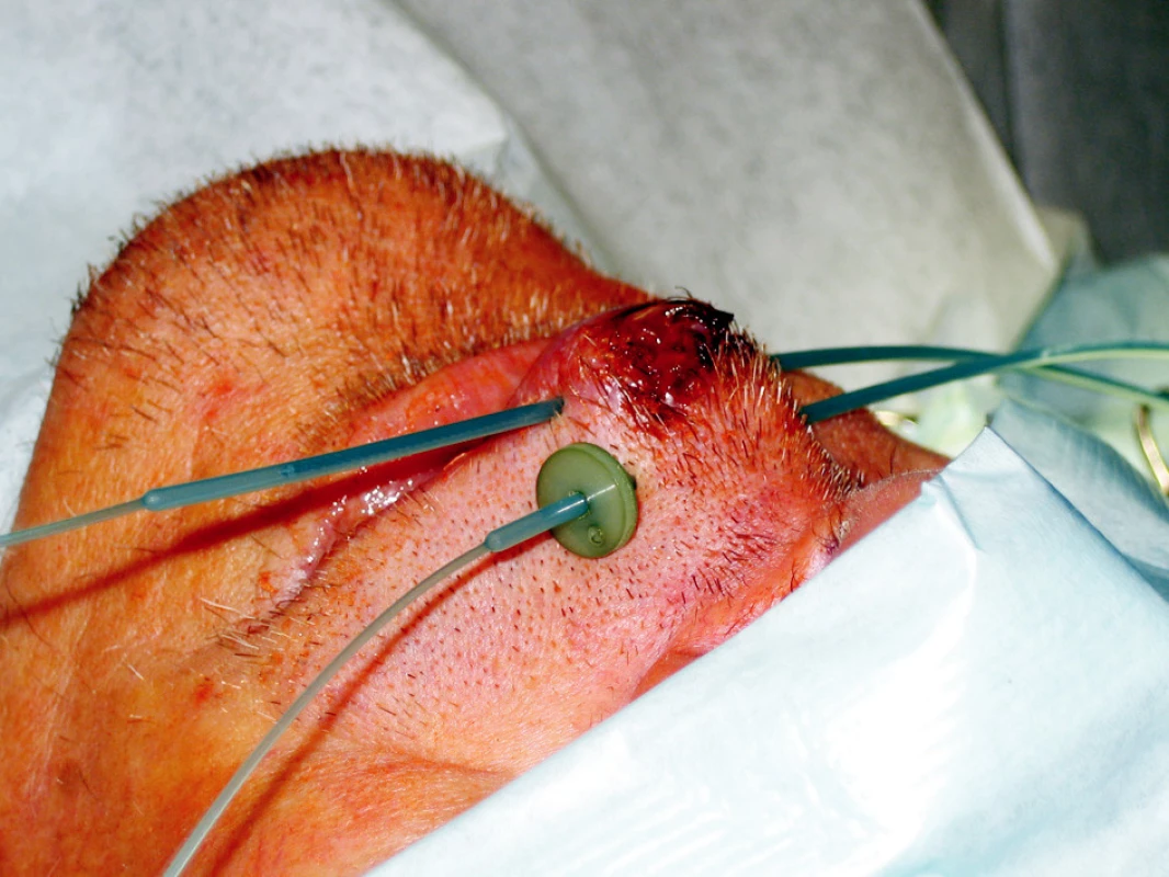 Intersticiální brachyterapie u pacienta s nádorem horního rtu
Fig. 3. Interstitial brachytherapy in a patient with an upper lip tumor