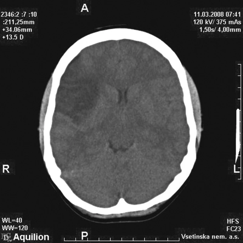 Nativní CT mozku s domnělou kontuzí vpravo 
Fig. 2. Native brain CT images with suspected contusion on the right