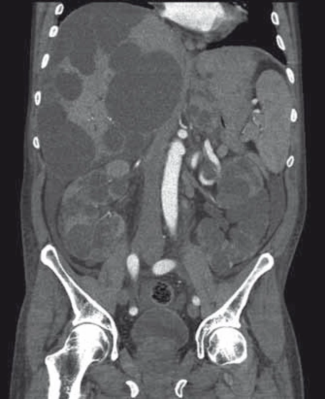 Zvětšení jater a ledvin významně změní anatomické poměry v dutině břišní.
Fig. 2. Liver and renal volume expansion signifcantly changes organ topografy of abdominal cavity.