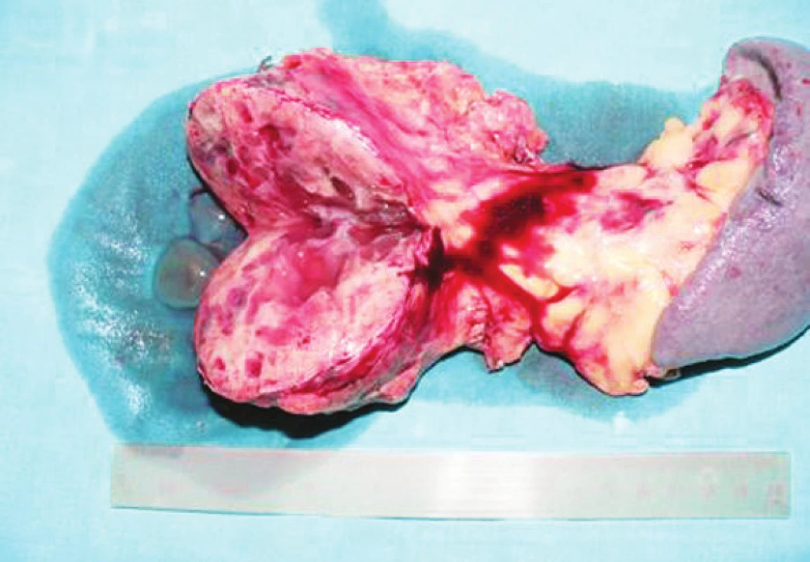 Rozrezaný tumor na dolnej hrane tela pankreasu
Fig. 9. Sliced tumor of the inferior pancreatic body margin