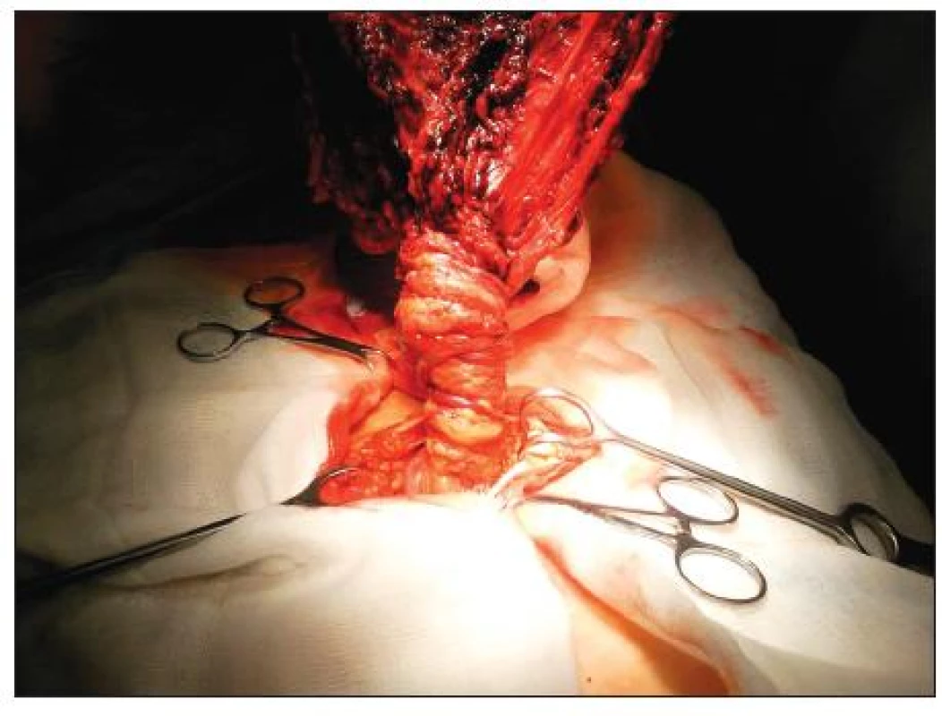Torze omenta v oblasti vaskulární stopky
Fig. 1. Torsion of the omentum in the vascular stalk region