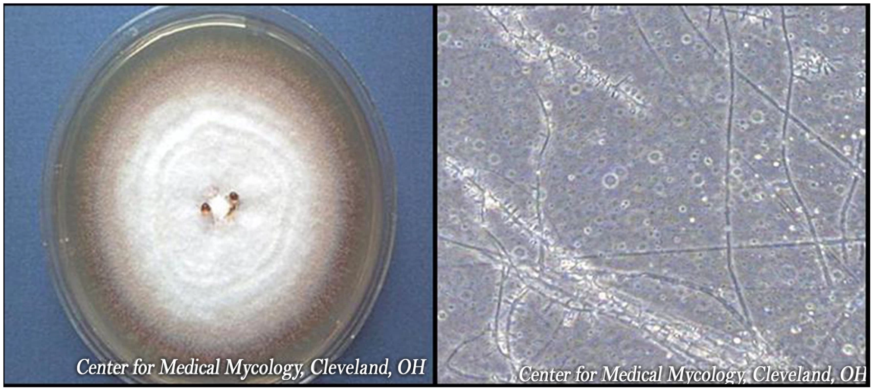 <i>Trichophyton rubrum</i> colony and microscopic appearance (40x).