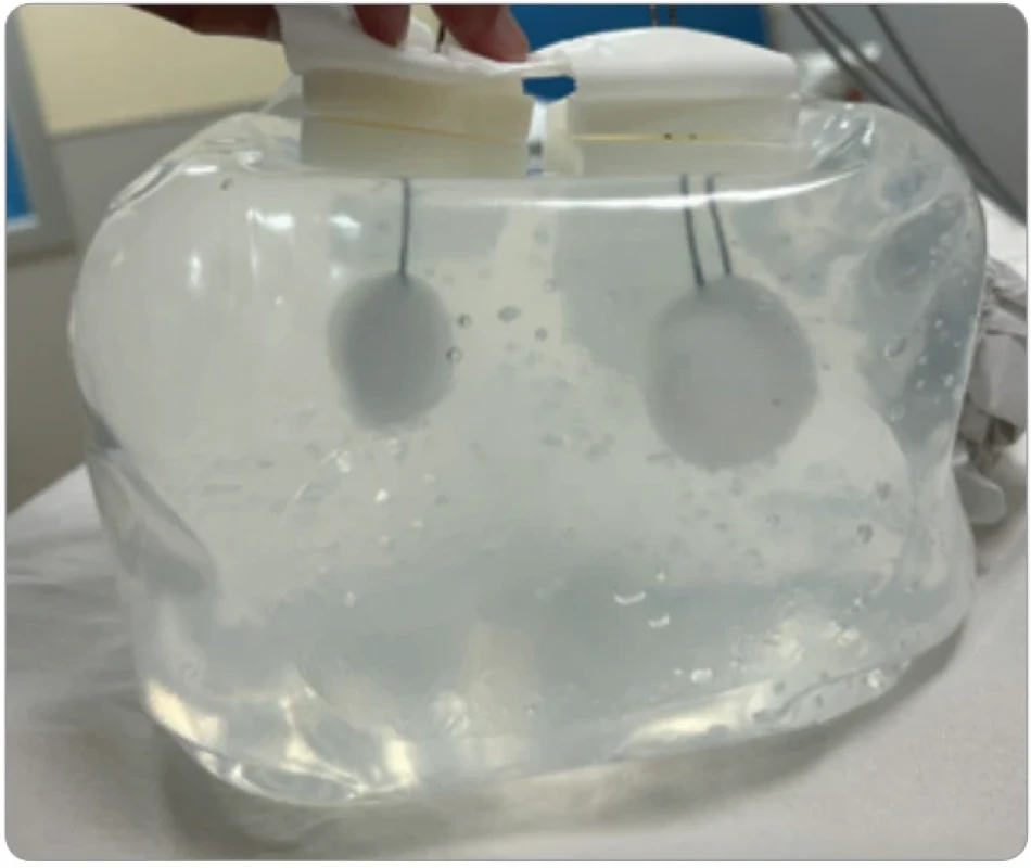 Ice ball generated by the single and double IceSphere™ needle confi gurations after a 10-minute freeze cycle at 100% freeze intensity.