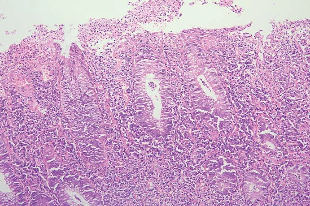Biopsie v sigmatu, eroze povrchového epitelu, kryptové abscesy.
