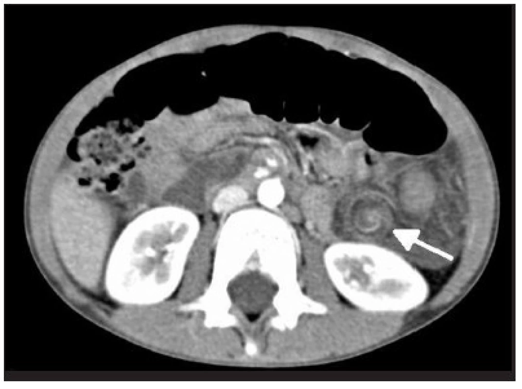 CT obraz typického špirálového útvaru pri torzii lienálnych ciev
Fig. 6. CT image of typical spiral formation in splenic vessel torsion