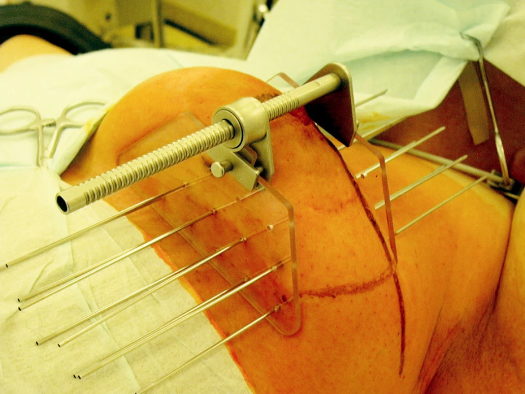 Provedení intersticiální brachyterapie lůžka tumoru po parciální mastektomii pomocí jehel a můstku
Fig. 1. Interstitial brachytherapy procedure of a tumor focus after partial mastectomy, using needles and a bridge