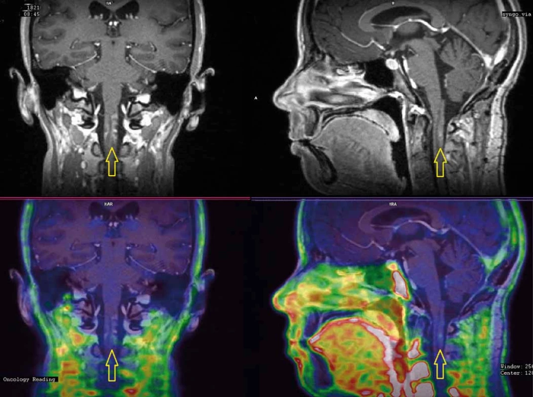 PET/MRI s FLT (fluorothymidin) provedené 18 měsíců po ozáření.
Vyšetření vyloučilo recidivu tumoru a ukázalo obraz regredující radionekrózy (A) s nevelkou akumulací FLT (fluorothymidin) a atrofií míšní (B).