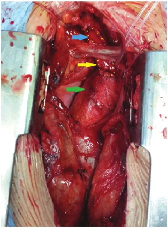 Peroperační nález, žlutá šipka − protetická plastika, zelená šipka − asc. aorta, modrá šipka − truncus brachiocephalicus
Fig. 3: Peroperative findings, yellow arrow − prosthetic patch, green arrow − ascending aorta, blue arrow − truncus brachiocephalicus