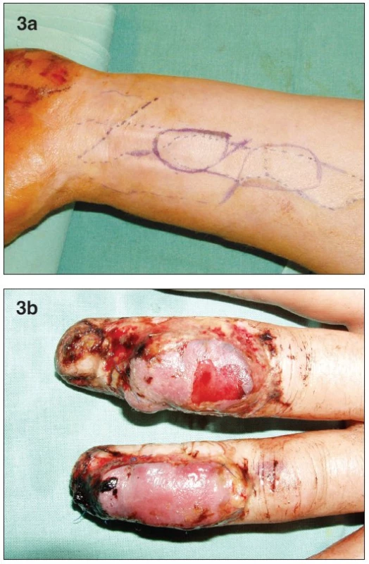 a. Design of both of the free flaps on the distal volar forearm
b. Postoperative swelling and bulae on both flaps on the 3rd day post-op
