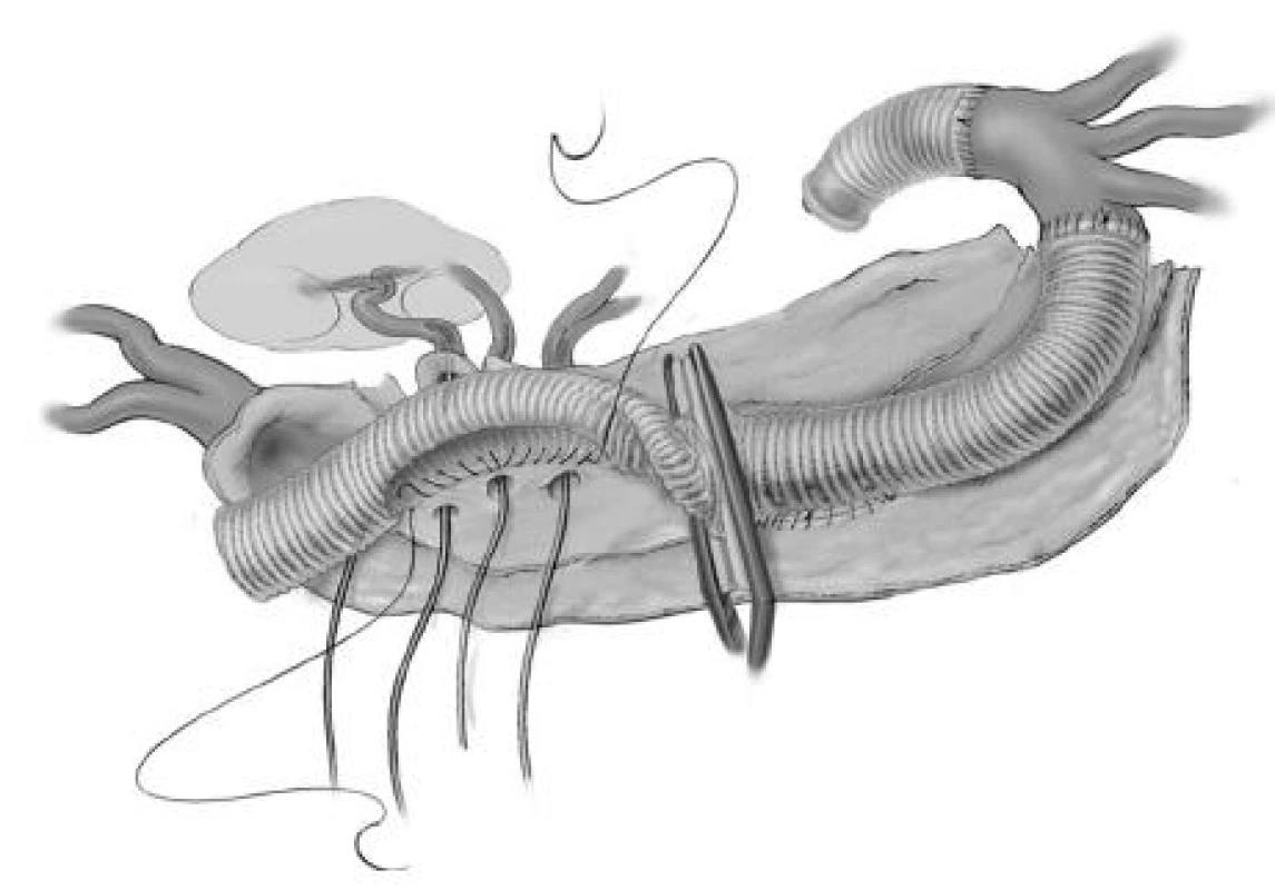 Postupné nakládání aortální svorky
Fig. 12. Gradual placement of the aortic clip