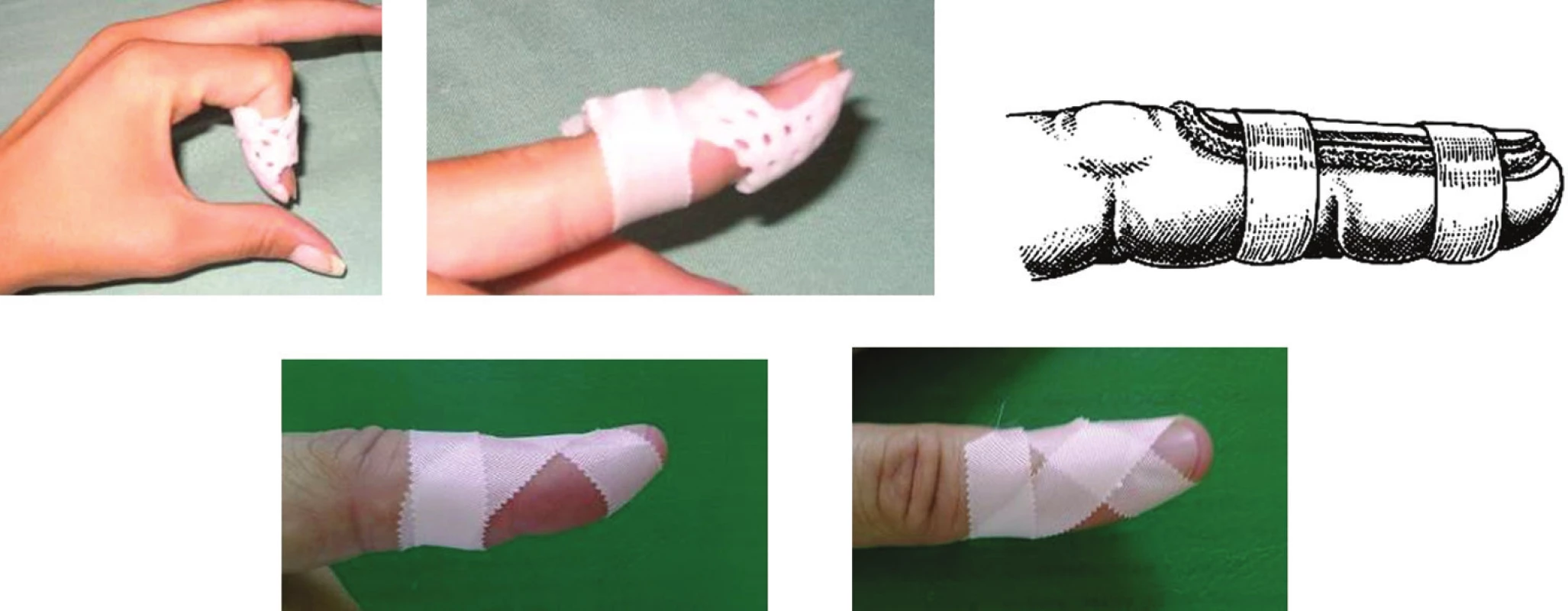 Dlahovanie a taping mallet deformity
Materiál z Ústavu chirurgie ruky a plastické chirurgie, Vysoké nad Jizerou, ČR, s povolením primára.
Fig. 2: Mallet deformity splinting and taping
Material from the Institute of Hand and Plastic Surgery, Vysoké nad Jizerou, CZ, with permission of the head of the institute.