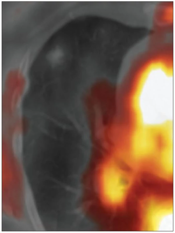 <sup>18</sup>F-FDG-PET/CT (06/2010). V ložisku není patrna patologická hyperutilizace glukózy.