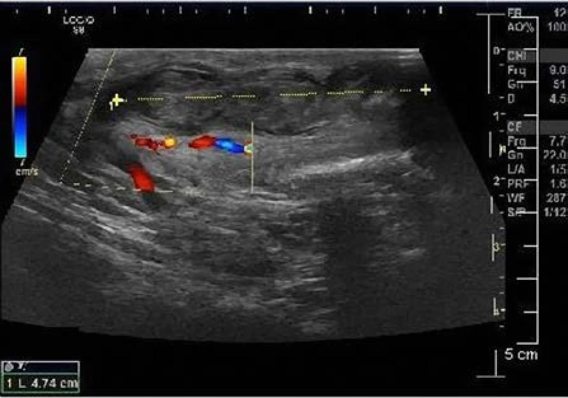Venózní trombóza v povrchové penilní žíle, bez známek toku v barevném mapování
Fig. 3 Venous thrombosis of the superficial penile vein, without flow seen on color Doppler imaging