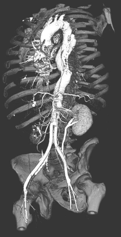 CTA kontrola po 2 letech od urgentní resekce subrenální aorty technikou aortální fenestrace s ABF rekonstrukcí. Retrográdní plnění dolního pólu pravé ledviny
Pic. 4 A CTA check up two years after the urgent resection procedure of the subrenal aorta using aortic fenestration with ABF reconstruction. Retrograde perfusion of the inferior pole of the right kidney