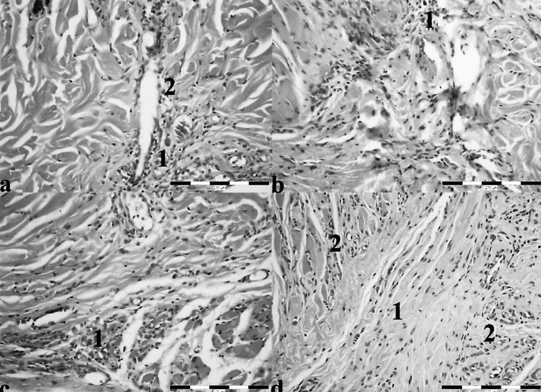 a. Kontrolná rana (diabetické potkany, HE, 400x), 1 – výrazná infiltrácia rany PMNL a makrofágmi, 2 – sporadické zastúpenie fibroblastov
Obr. 2b. Stimulovaná rana – intenzita 1 mW/cm2, (diabetické potkany, HE, 400x), 1 – neoangiogenéza
Obr. 2c. Stimulovaná rana – intenzita 5 mW/cm2, (diabetické potkany, HE, 400x), 1 – granulačné tkanivo s bohatou neoangiogenézou
Obr. 2d. Stimulovaná rana intenzita 15 mW/cm2, (diabetické potkany, HE, 400), 1 – mierna infiltrácia rany PMNL a makrofágmi, 2 – granulačné tkanivo