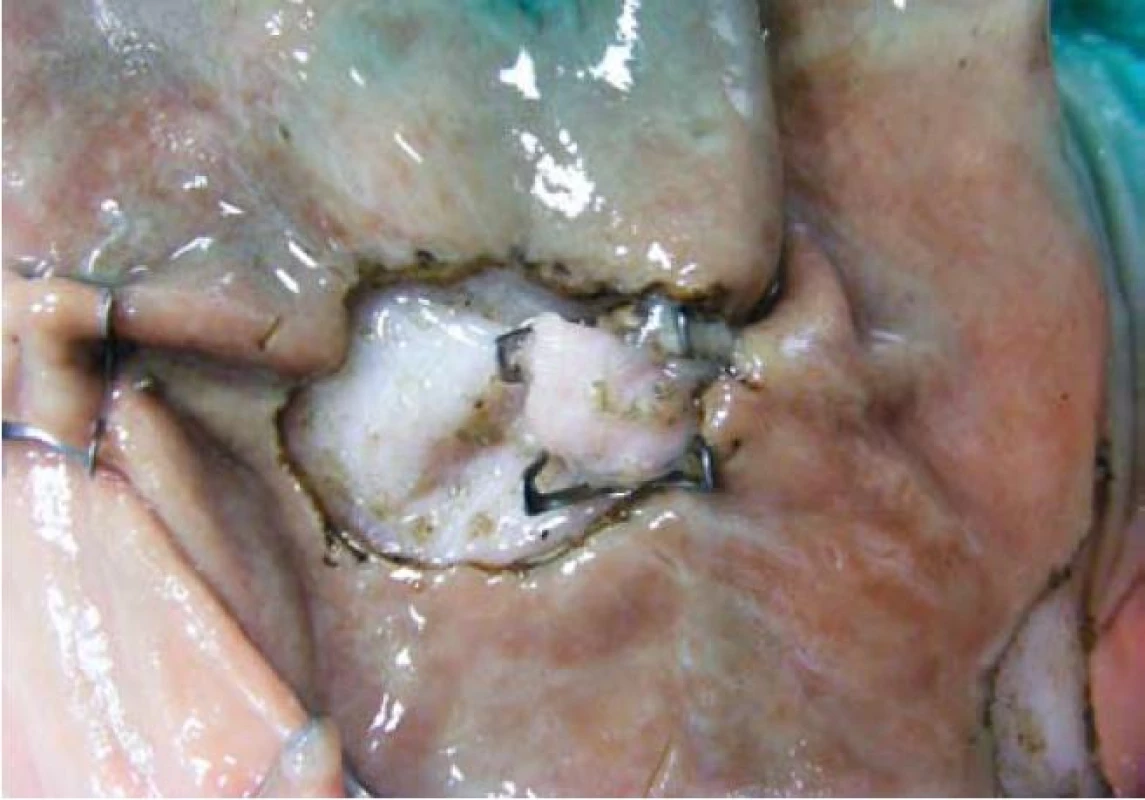 Aplikovaný OV ESCO klip na artificiální perforaci v místě předchozí endoskopické disekce.
Fig. 6. OVESCO clip applied to an artificial perforation at the site of a previous endoscopic dissection.