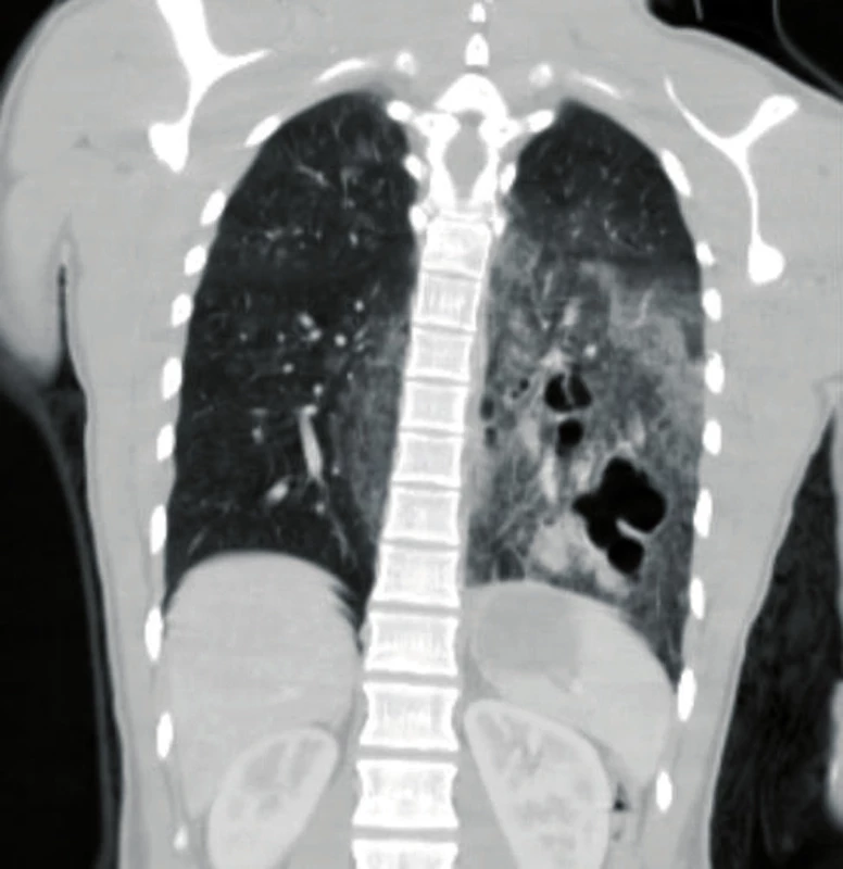 Coronal CT