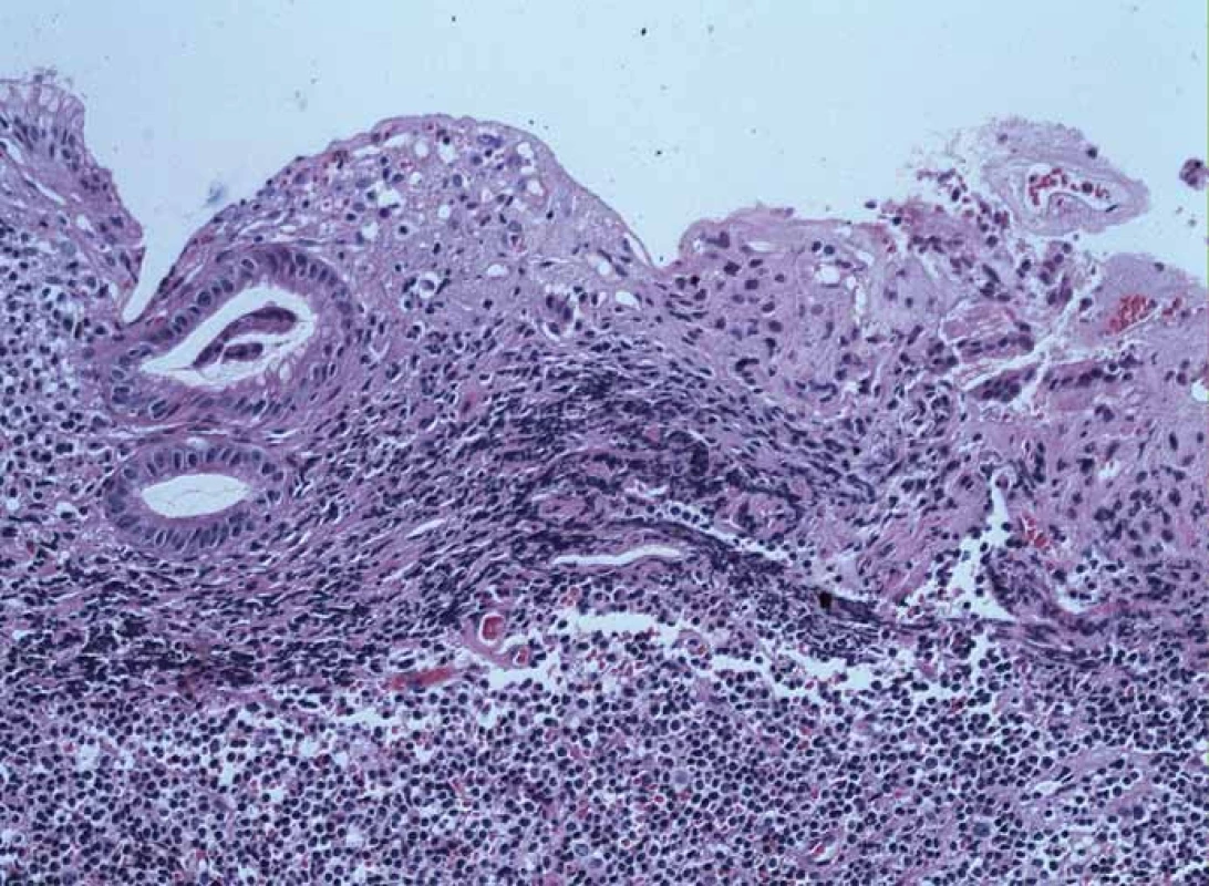 Histologická diagnóza, barvení hematoxylin-eozin.
Fig. 4. Histologic diagnosis, haematoxylin-eosin staining.