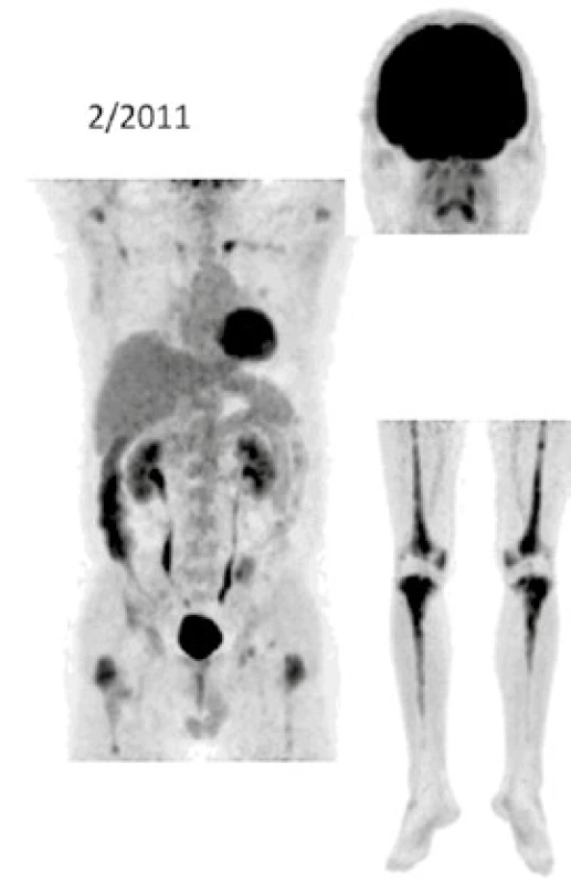 FDG-PET/CT zobrazení pacienta v roce 2011 před zahájením léčby anakinrou
Při low-dose CT zobrazení, které bylo součástí PET/CT vyšetření, byla patrná četná osteosklerotická ložiska ve skeletu zvláště v dolních končetinách se zvýšenou akumulací <sup>18</sup>F-fluorodeoxyglukózy (FDG)